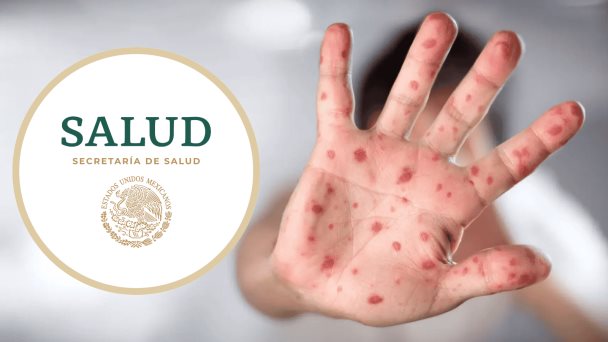 Recomendaciones para prevenir el MPOX - Secretaria de Salud